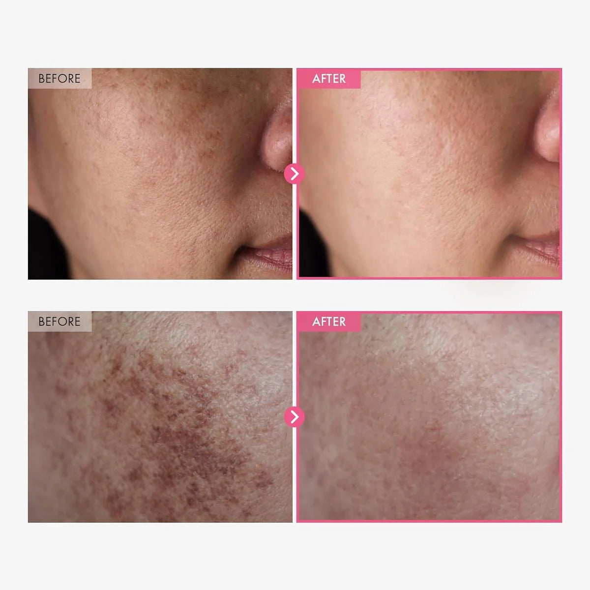 Tosowoong - Arbutin 7% + Tranexamic Acid 4% Cream